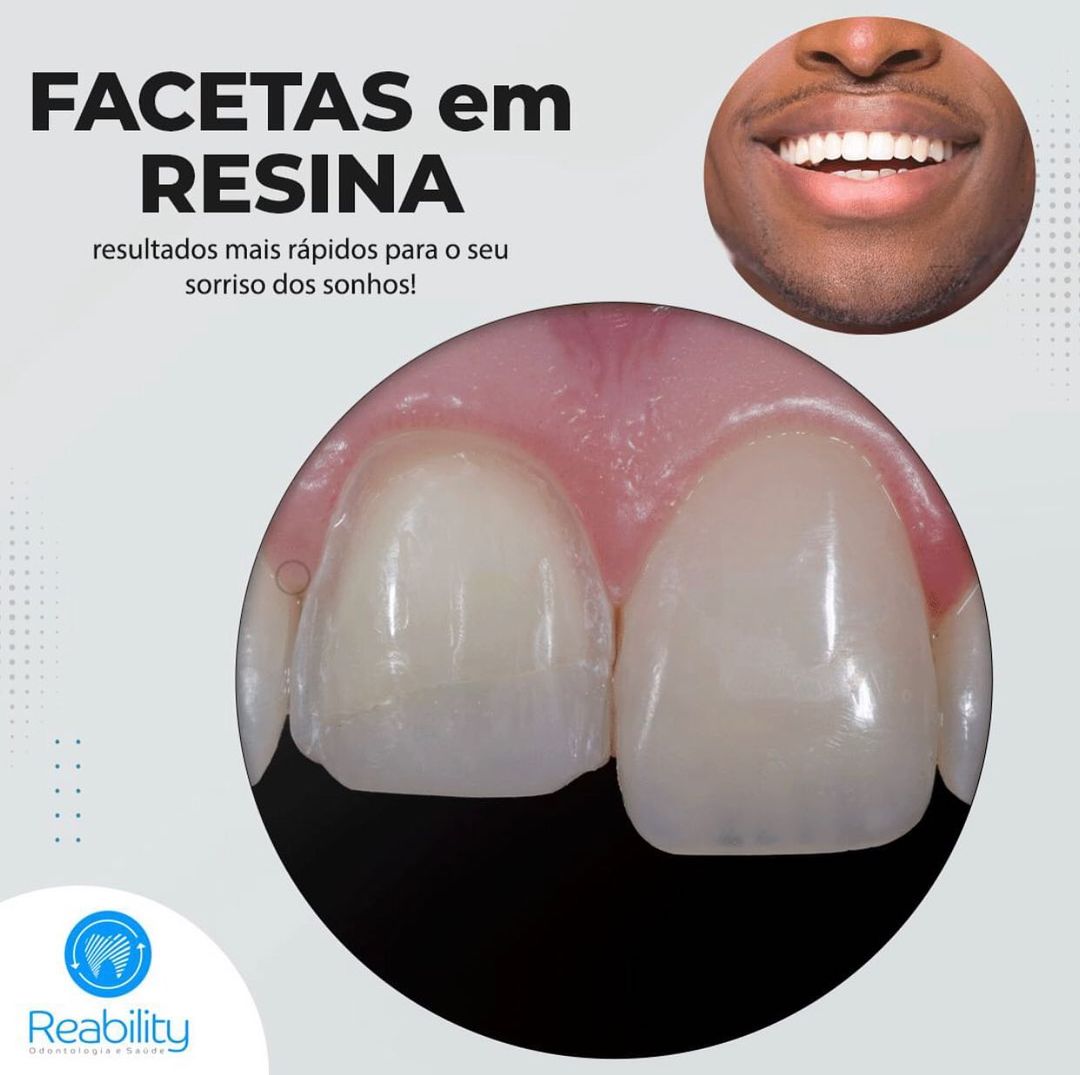 PODER DEIXAR OS DENTES PERFEITOS NO MESMO DIA É POSSÍVEL!