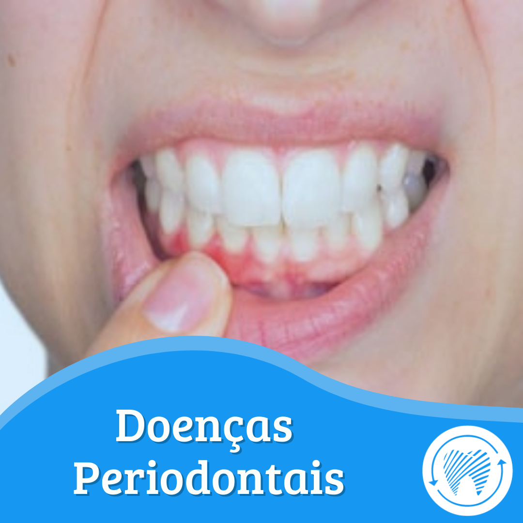 Doenças Periodontais: Causas e Prevenção